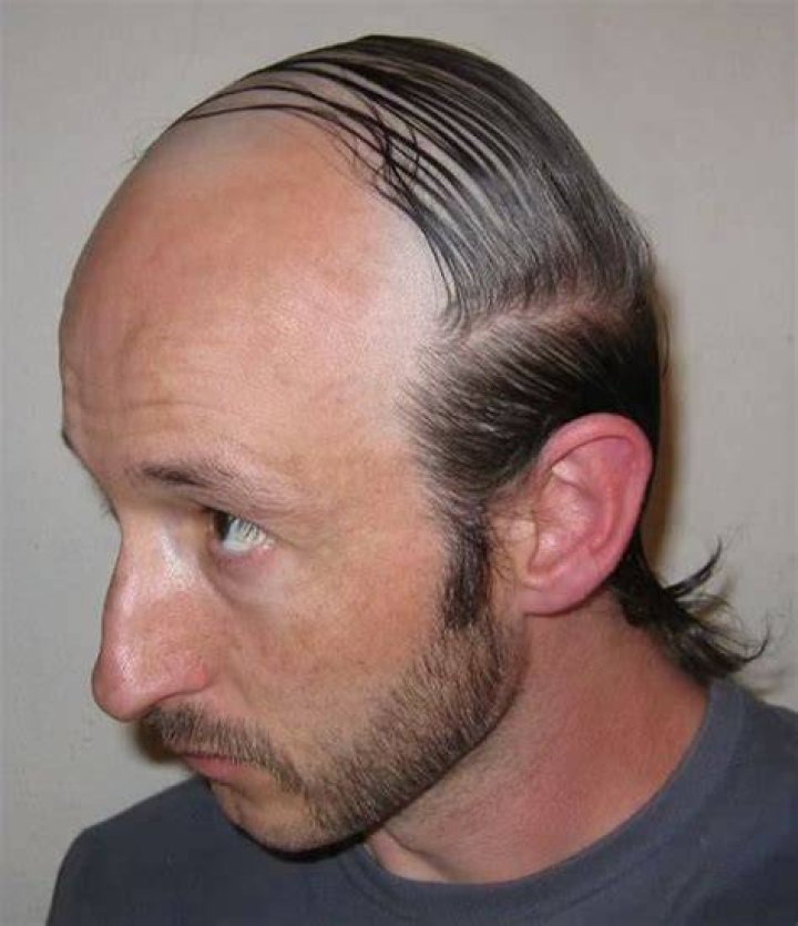bald braided comb over by Hair Holland Braids Hairstyles Pictures