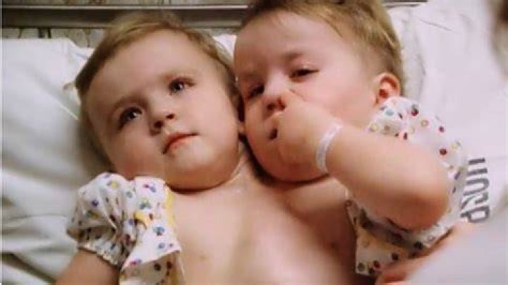 Eilish Holton Now Conjoined twins, Holton, New career