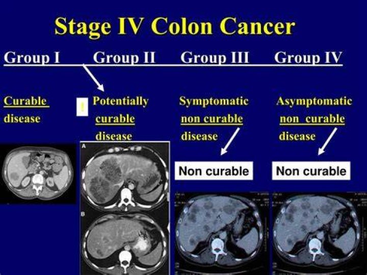 Stage IV Colon Cancer Trial Exhibits Inc.