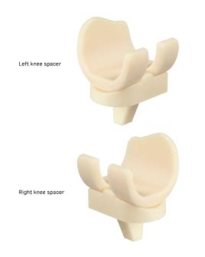 The REMEDY® Stemmed Knee Spacer's interconnected pores allow for extended antibiotic elution while improving OR efficiency vs handmade IM dowels. The REMEDY® Stemmed Knee Spacer's interconnected pores allow for extended antibiotic elution while improving OR efficiency vs handmade IM dowels.
