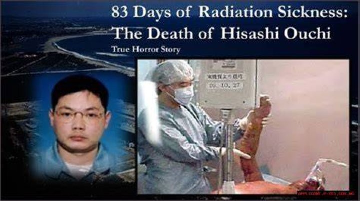 The Tragic Case Of Hisashi Ouchi Radiation Burns And The Worst