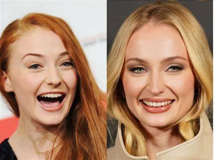This is Sophie Turner after Buccal fat removal r/PaymoneyWubby